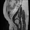 Atypical retroperitoneal lymphocoeles with large leiomyoma of uterus (Radiopaedia 32084-33027 Sagittal T2 30).jpg