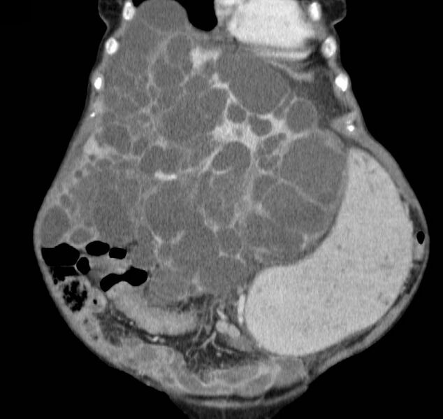 File:Autosomal dominant polycystic kidney disease (Radiopaedia 16777-16490 B 9).jpg