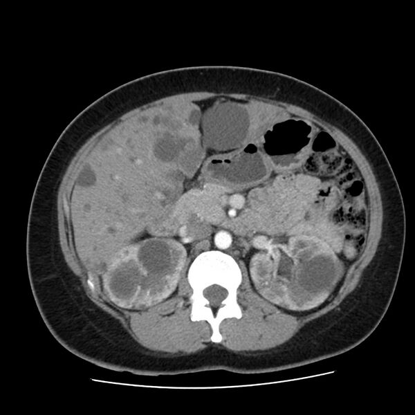 File:Autosomal dominant polycystic kidney disease (Radiopaedia 23061-23093 B 26).jpg