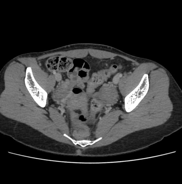 File:Autosomal dominant polycystic kidney disease - early onset (Radiopaedia 40734-43387 A 72).jpg