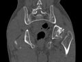 Avascular necrosis of the left hip (Radiopaedia 75068-86125 Coronal bone window 69).jpg