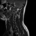 Axis fracture - MRI (Radiopaedia 71925-82375 Sagittal T2 1).jpg
