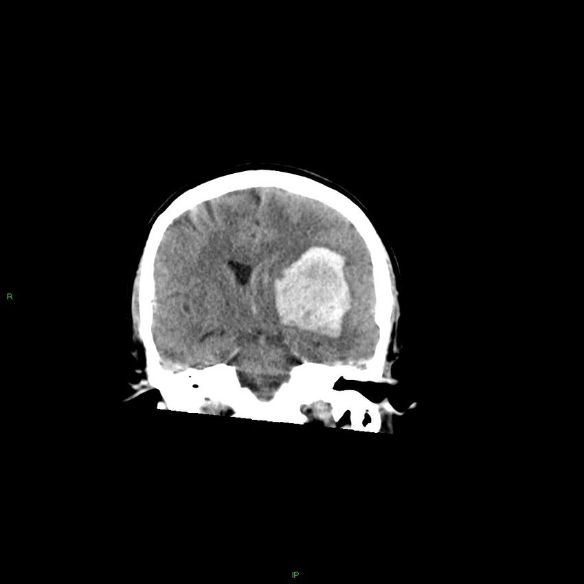 Basal ganglia hemorrhage (Radiopaedia 58349-65472 Coronal non-contrast 35).jpg