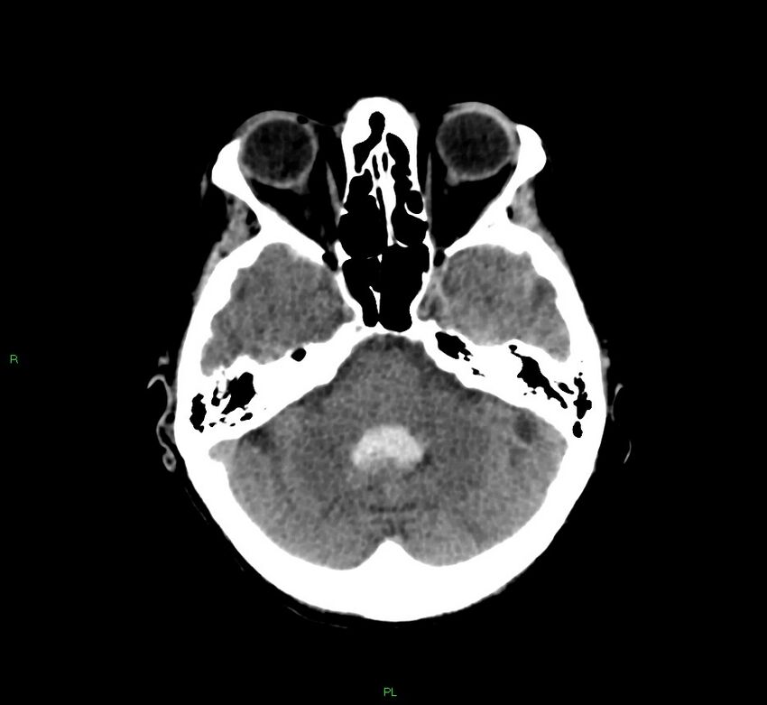 Basal ganglia hemorrhage (Radiopaedia 58766-65988 Axial non-contrast 42).jpg