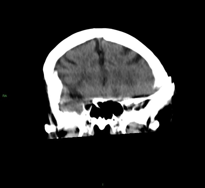 File:Basal ganglia hemorrhage (Radiopaedia 58790-66024 Coronal non-contrast 41).jpg