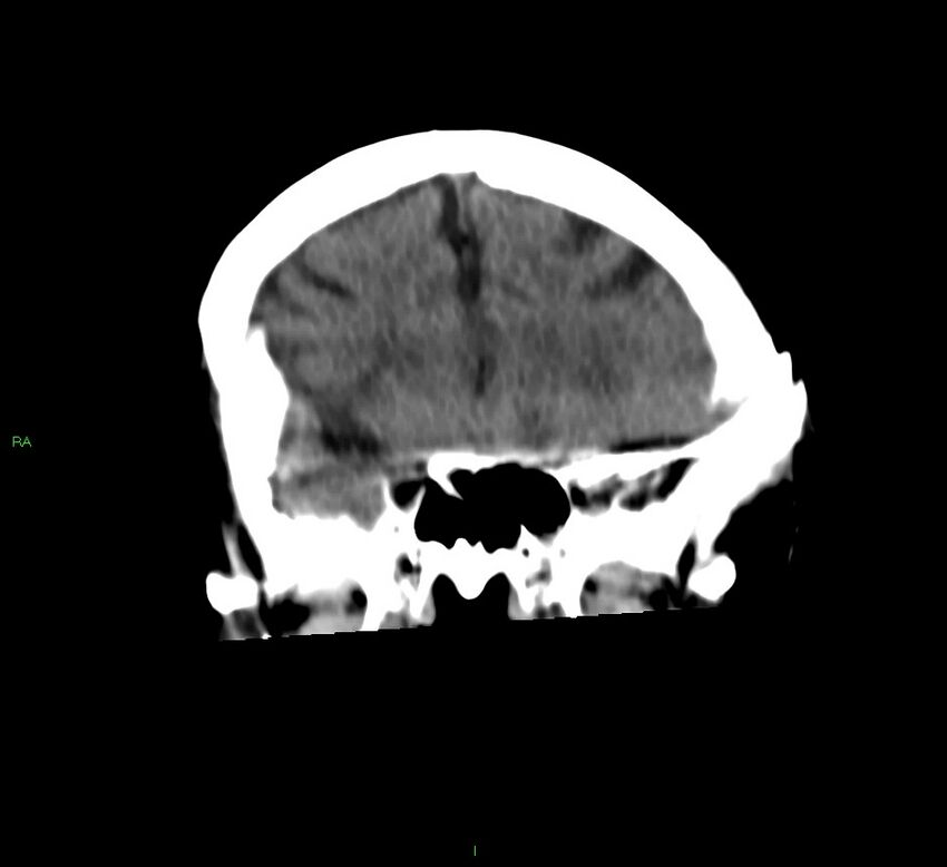 Basal ganglia hemorrhage (Radiopaedia 58790-66024 Coronal non-contrast 41).jpg