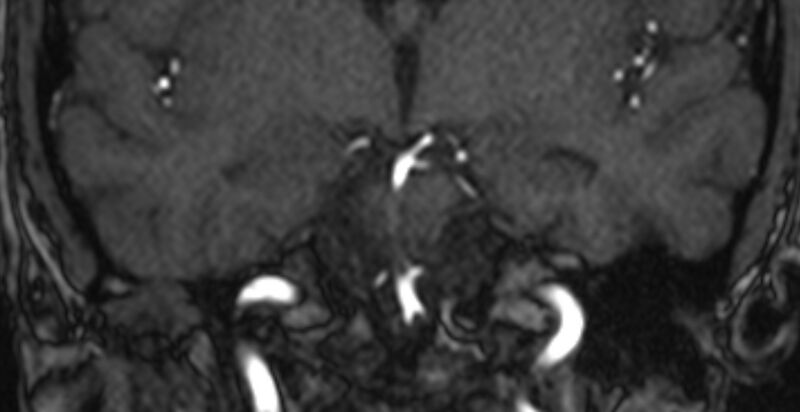 File:Basilar artery fenestration (Radiopaedia 74537-85455 Coronal MRA TOF 42).jpg