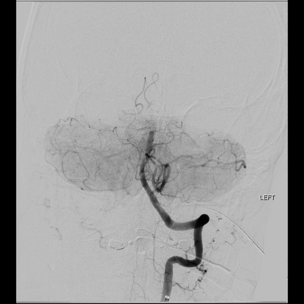 File:Basilar tip thrombus with endovascular clot retrieval (Radiopaedia 46320-50726 B 12).png
