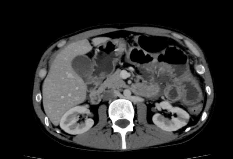 File:Behçet's disease- abdominal vasculitis (Radiopaedia 55955-62570 A 29).jpg