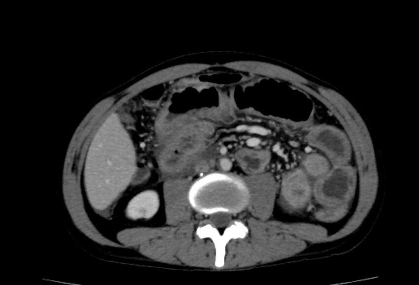 Behçet's disease- abdominal vasculitis (Radiopaedia 55955-62570 A 41).jpg