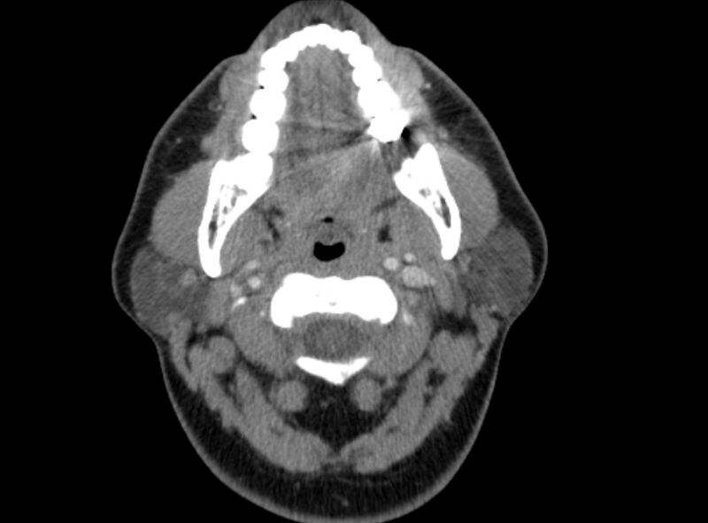 File:Benign mixed salivary tumor of the parotid gland (Radiopaedia 35261-36792 A 19).jpg