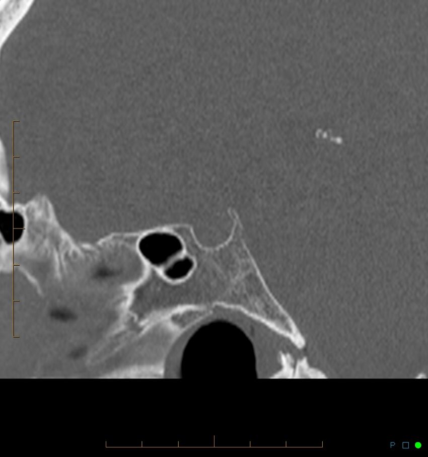 Benign notochordal cell tumor (probable) (Radiopaedia 65475-74546 Sagittal bone window 23).jpg