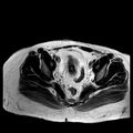 Benign seromucinous cystadenoma of the ovary (Radiopaedia 71065-81300 B 8).jpg