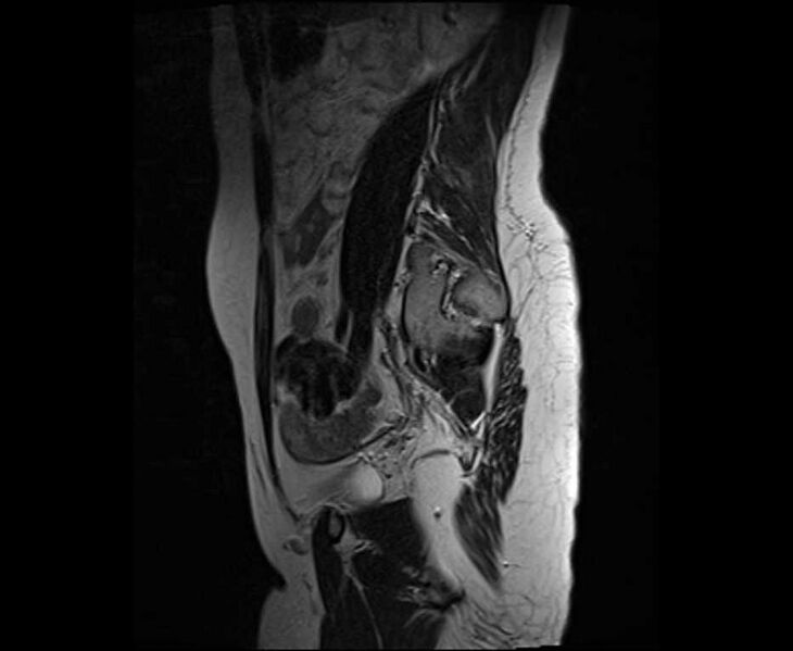 File:Bicornuate bicollis uterus (Radiopaedia 61626-69616 Sagittal T2 10).jpg