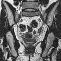 Bicornuate uterus (Radiopaedia 11104-11492 Coronal T2 16).jpg