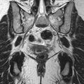 Bicornuate uterus (Radiopaedia 11104-11492 Coronal T2 22).jpg
