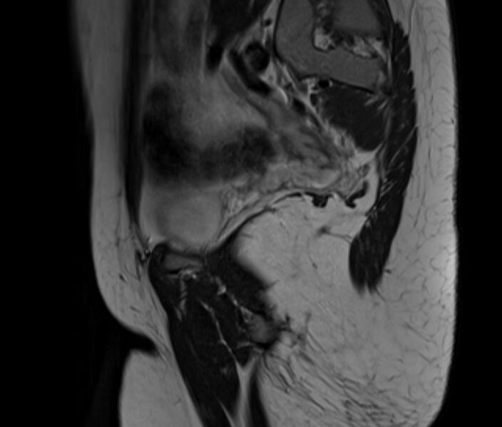 File:Bicornuate uterus (Radiopaedia 71214-81511 Sagittal T2 4).jpg