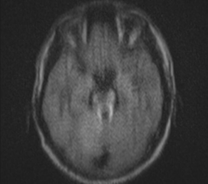 File:Bilateral cholesteatoma (Radiopaedia 54898-61173 Axial DWI 11).jpg