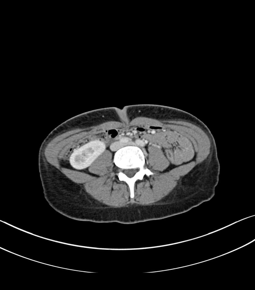 Bilateral kidney malrotation (Radiopaedia 72227-82749 A 41).jpg