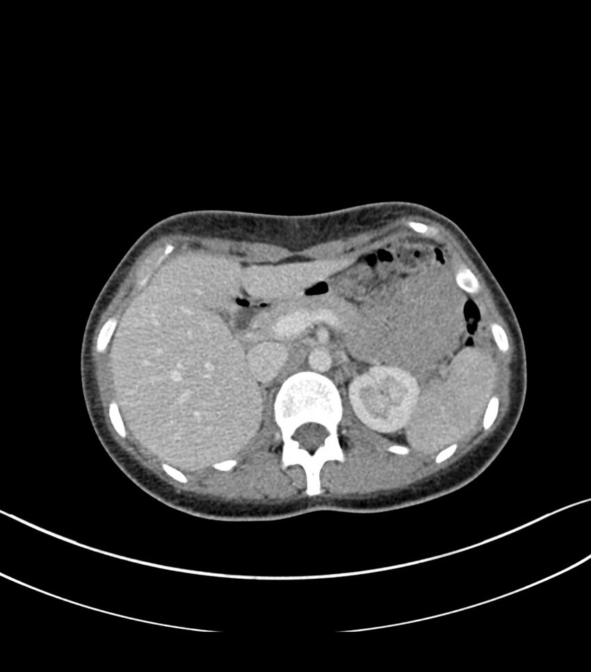 Bilateral kidney malrotation (Radiopaedia 72227-82749 A 7).jpg