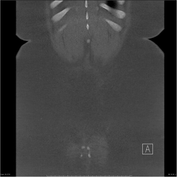 File:Bilateral lumbar ribs (Radiopaedia 25862-26010 Coronal bone window 26).jpg