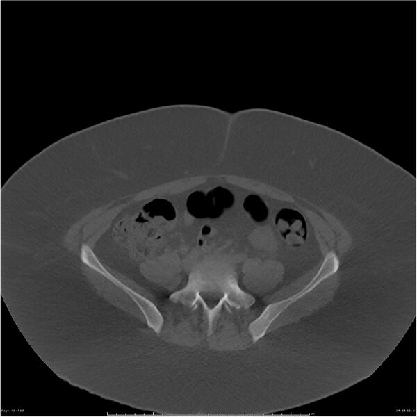 File:Bilateral lumbar ribs (Radiopaedia 25862-26010 bone window 40).jpg
