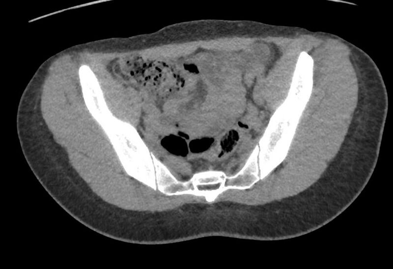 File:Bilateral mature cystic ovarian teratoma (Radiopaedia 88821-105592 Axial non-contrast 4).jpg