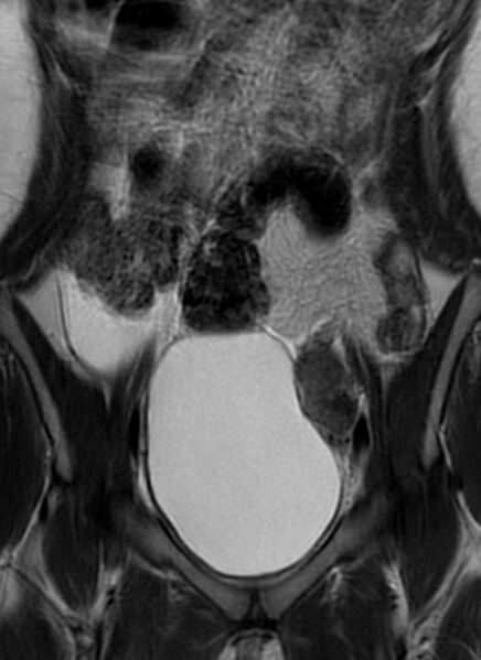 File:Bilateral ovarian fibrothecomas - adolescent (Radiopaedia 86604-102707 Coronal T2 12).jpg