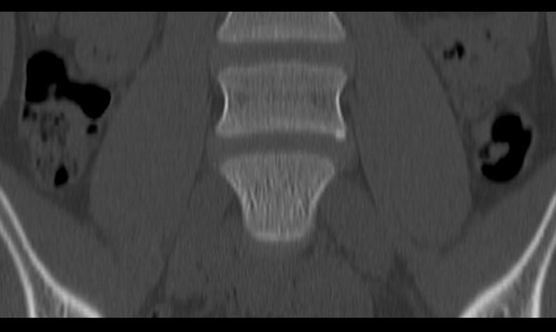 File:Bilateral pars defect (Radiopaedia 26691-26846 Coronal bone window 12).jpg