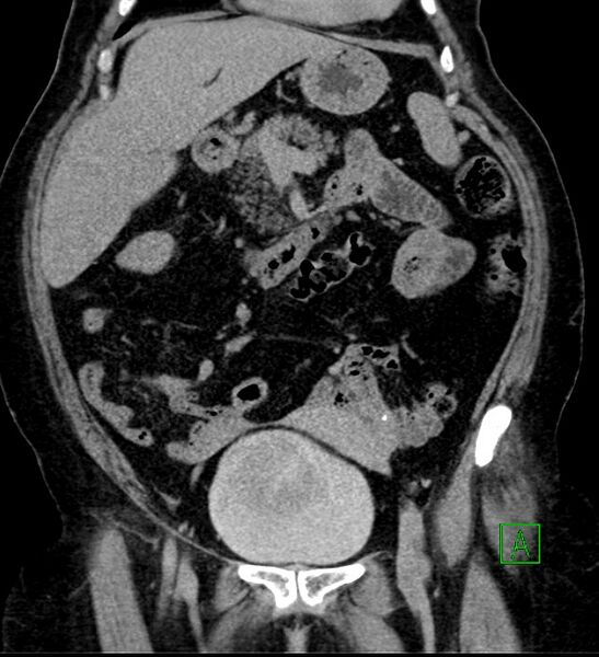 File:Bilateral sporadic synchronous clear cell renal cell carcinoma (Radiopaedia 85035-100575 I 15).jpg