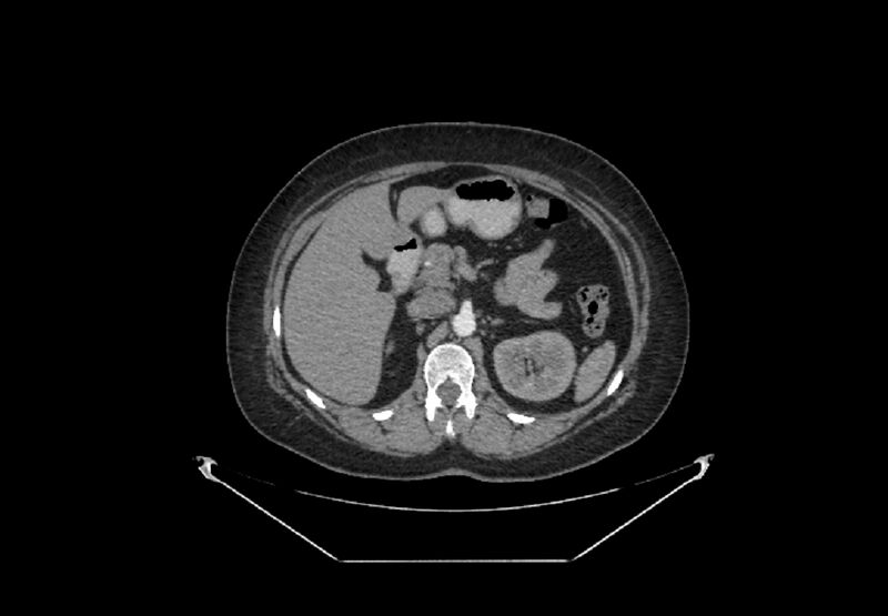 File:Bilateral urolithiasis with incidentally detected splenic artery aneurysm and left inferior vena cava (Radiopaedia 44467-48127 A 25).jpg