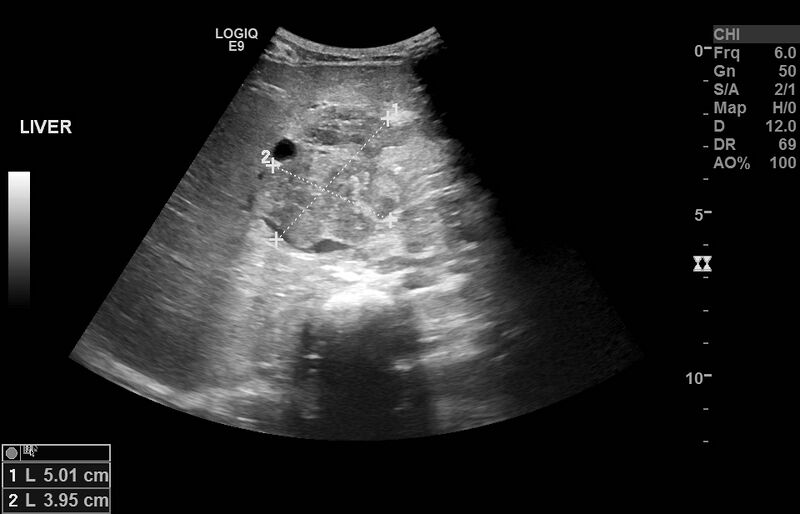 File:Biliary tract embryonal rhabdomyosarcoma (Radiopaedia 51815-57615 Transverse 1).jpg