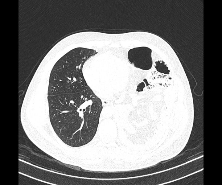 File:Bochdalek hernia - adult presentation (Radiopaedia 74897-85925 Axial lung window 29).jpg