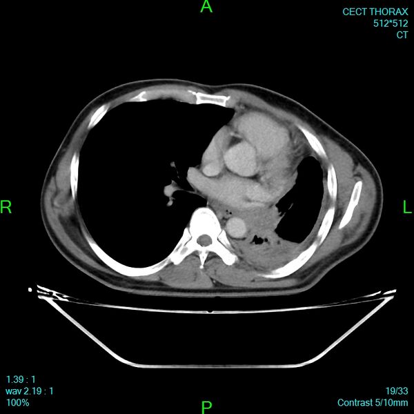 File:Bone metastases from lung carcinoma (Radiopaedia 54703-60937 Axial C+ delayed 19).jpg