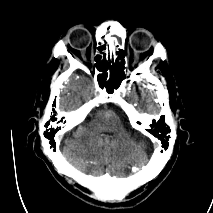 Brain Pantopaque remnants (Radiopaedia 78403-91048 Axial non-contrast 32).jpg