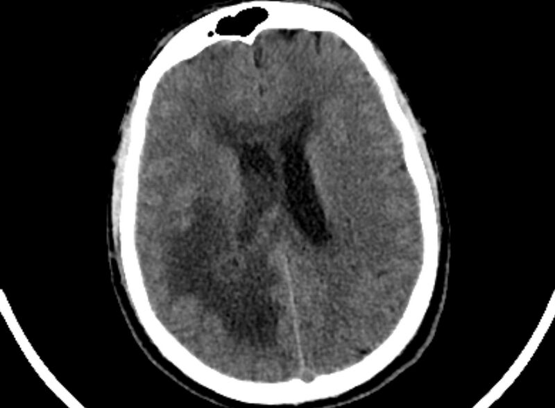 File:Brain abscess complicated by intraventricular rupture and ventriculitis (Radiopaedia 82434-96575 Axial non-contrast 68).jpg