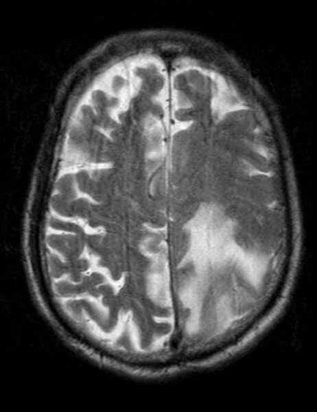 File:Brain abscess with dual rim sign (Radiopaedia 87566-103938 Axial T2 18).jpg