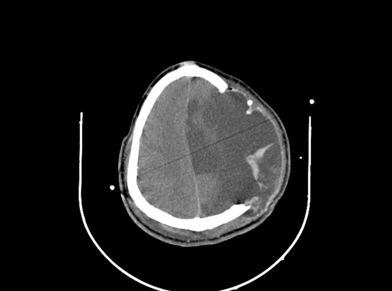 File:Brain injury by firearm projectile (Radiopaedia 82068-96087 B 140).jpg