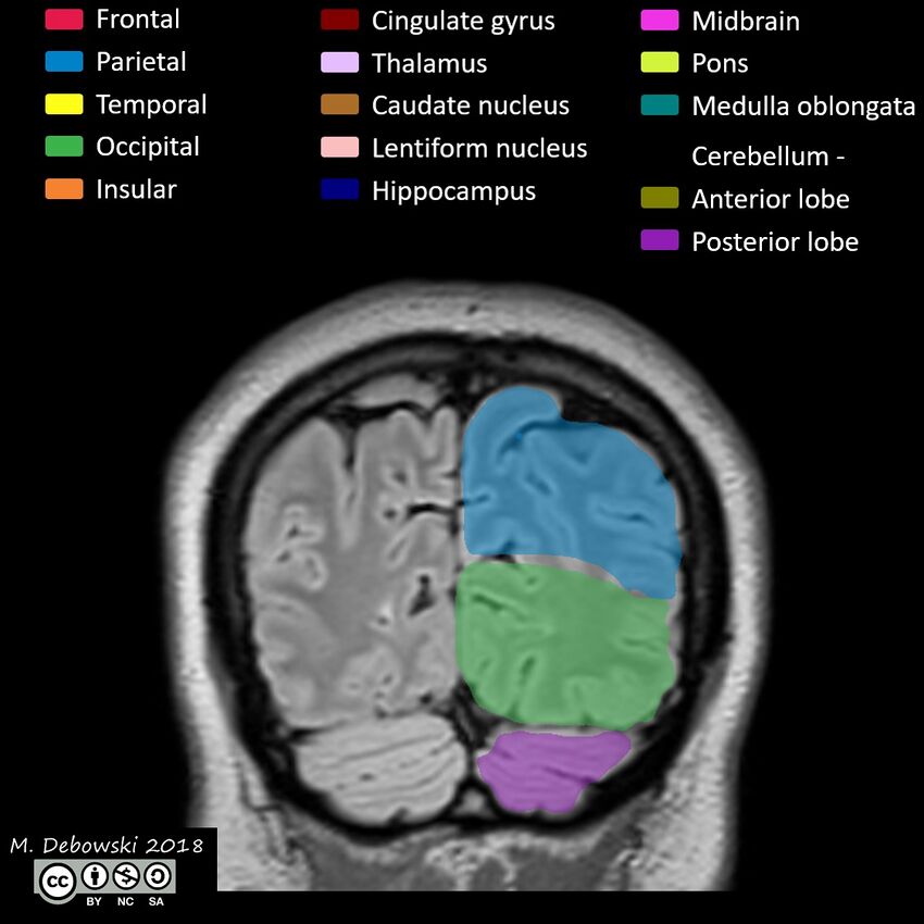 Brain lobes - annotated MRI (Radiopaedia 61691-69700 Coronal 63).JPG