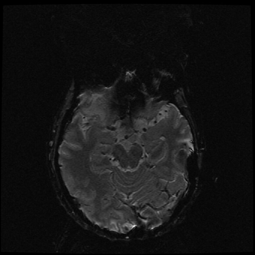 Brain metastases (renal cell carcinoma) (Radiopaedia 42571-45704 Axial SWI 40).jpg