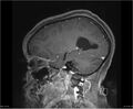 Brainstem glioma (Radiopaedia 21819-21775 D 13).jpg
