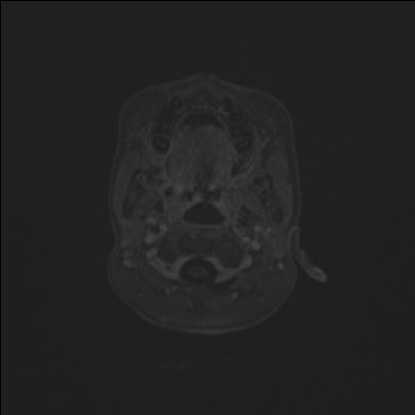 File:Brainstem glioma (Radiopaedia 70548-80674 Axial T1 C+ 5).jpg