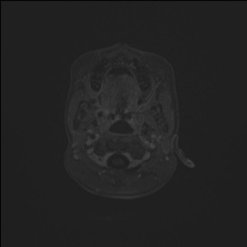 Brainstem glioma (Radiopaedia 70548-80674 Axial T1 C+ 5).jpg