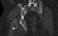 Breast carcinoma with pathological hip fracture (Radiopaedia 60314-67993 Coronal bone window 81).jpg