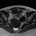 Broad ligament fibroid (Radiopaedia 49135-54241 Axial T2 18).jpg