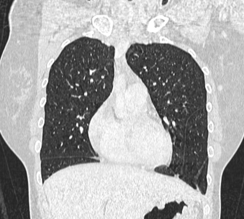 Bronchial atresia (Radiopaedia 50007-55297 Coronal lung window 28).jpg