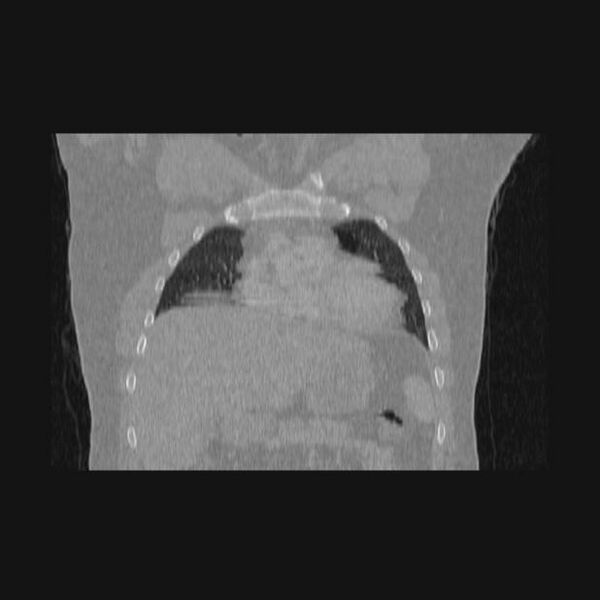 File:Bronchial atresia (Radiopaedia 60685-68439 Coronal lung window 55).jpg
