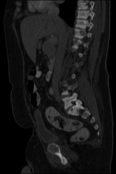 File:Brown tumors compressing the spinal cord (Radiopaedia 68442-77988 H 26).jpg