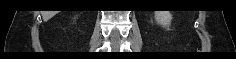 File:Buried bumper syndrome - gastrostomy tube (Radiopaedia 63843-72575 Coronal 56).jpg
