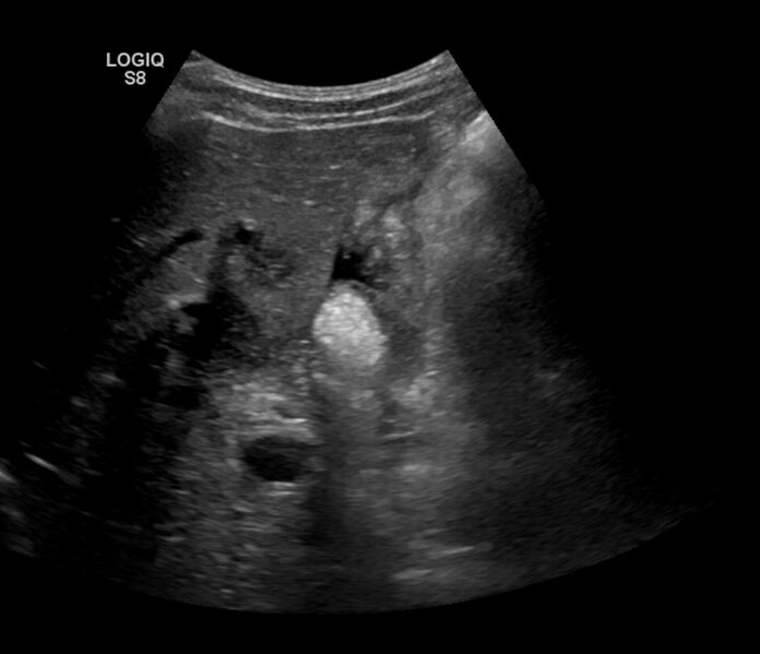 File:Burkitt lymphoma (bowel) (Radiopaedia 68839-78556 A 2).jpg